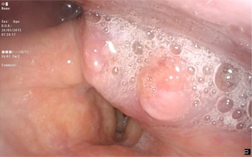 Figure 3 Case 6: fiber-optic examination before surgery.