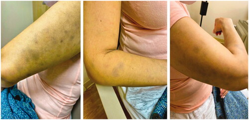 Figure 1. Patient’s bilateral upper outer arms and forearms with distinct, ill-defined, blue-gray pigmented macules and patches.