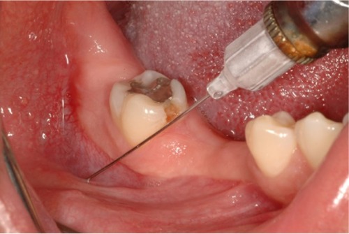 Figure 1 Mandibular infiltration is delivered to the facial aspect of the mandible.