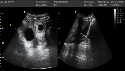 Figure 1 Visible intrauterine pregnancy with fetal pole (A), yolk sac (B), left adnexal cyst (C), and significant hemoperitoneum extending to the Morrison’s pouch (D).