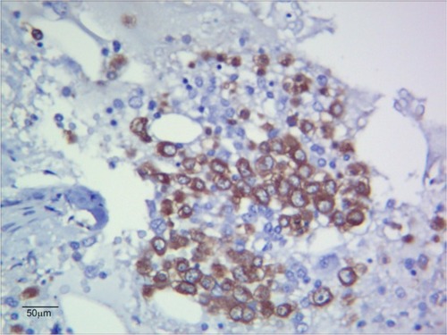 Figure 3 Immunohistochemistry (MPO 10×40).