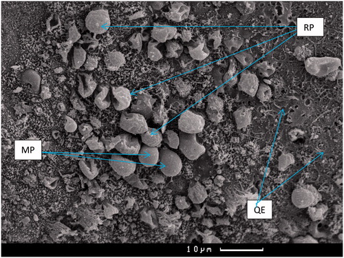 Figure 3. Asynchrony of pinopodia ripening: “quiet” epithelium (SE) fields are combined with islands of mature (MP) and ripening (RP) pinopodia. SEM of the surface epithelium of the endometrium.