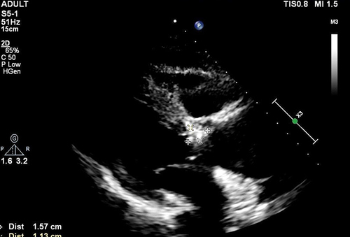 Figure 2 The results of transesophageal echocardiography.