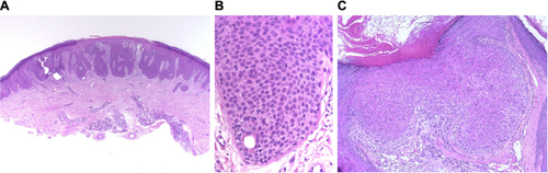 Figure 3 Predominantly epidermal tumors with basophilic, eosinophilic or clear cytoplasms.