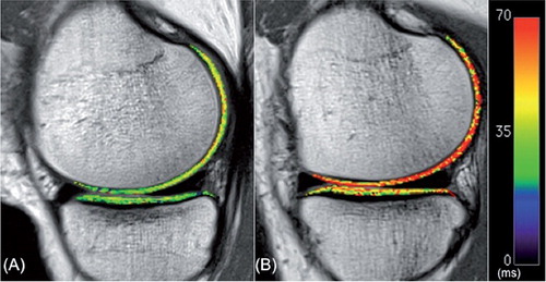 Figure 2. Color-coded sagittal T2 maps in the medial compartment of the contralateral knee (A) and the ACL-reconstructed knee (B) of one patient. Note the elevated T2 values of articular cartilage in the femoral compartment of the ACL-reconstructed knee relative to the contralateral knee.