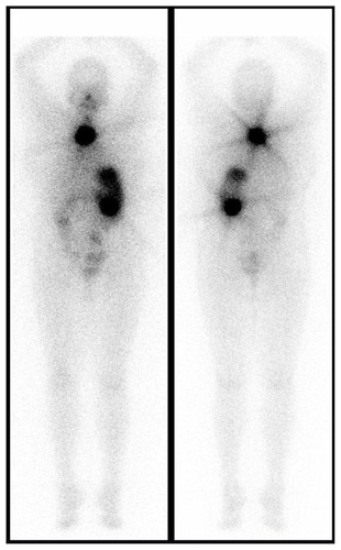 Figure 2 Preoperative 131I-WBS.