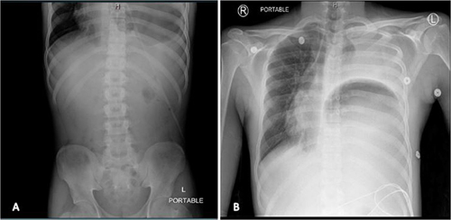 Figure 1 (A) Nonobstructive bowel gas pattern with minimal to absent air in the bowel loops. Haziness in left lung base due to left effusion with possible left basilar atelectasis. (B) Diffuse opacification of the left hemithorax with a large curvilinear lucency within the left hemithorax which were concerning for possible left diaphragmatic hernia.