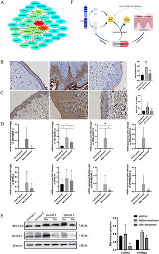 Figure 5 Hub gene screening and verification. (A) Protein–protein interaction network of light-green module genes. The edge represents interactions between genes. A degree is used to describe the importance of the protein nodes in the network. (B) Immunohistochemical staining for CNFN and IOD values of CNFN. (C) Immunohistochemical staining for S100A8 IOD values of S100A8. (D) qRT-PCR of CNFN, S100A8, SPRR2A, SPRR2D, and SPRR2E mRNA expression. (E) Western blotting of S100A8, SPRR2A. (F) Schematic diagram of the relationship between EDC and psoriasis and oxymatrine. *vs normal group, *p < 0.05, **p < 0.01, #vs before treatment, #p < 0.05, ##p < 0.01.