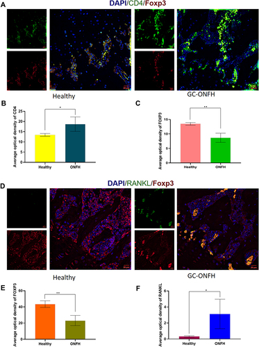 Figure 2 (A) Immunofluorescence assay for CD4 and FOXP3 stained lymphocytes in the bone marrows of healthy and GC-ONFH. (B and C) Statistical analysis depicting the mean optical density (MOD) of specific indicators in different study groups. (D) Immunofluorescence assay for FOXP3 and RANKL stained lymphocytes in the bone marrows of healthy and GC-ONFH. (E and F) Statistical analysis depicting the mean optical density (MOD) of specific indicators in different study groups. Data represent the mean ±SD. *P <0 0.05 and **P<0.01 compared with healthy controls.