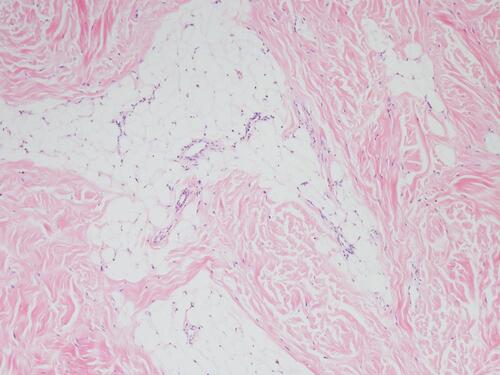 Figure 2 Histopathological biopsy revealed ectopic mature adipocytes interspersed with collagen bundles and proliferating in the dermis (Hematoxylin and eosin; ×40).