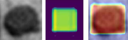 Figure 11. CRC LN classification heat-map. Left is the original image; the middle is the feature heat-map; right is the superimposed image