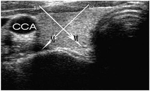Figure 3. On transverse scan, we can divide the thyroid gland into four quadrants. For a nodule located in the lower inner quadrant, the MW ablation was conducted through lateral cervical approach (R1), but for a nodule located in the lower outer quadrant, a median line approach MW ablation therapy was used (R2). If the nodule was located in one of the other two quadrants, either approach was acceptable. The core principle of the puncture route we adopted was not only that the MW antenna could be percutaneously inserted into the tumour and positioned in its designated place, but that injury of the major structures (carotid artery, trachea, oesophagus) could also be avoided. CCA, common carotid artery; M, tumour.