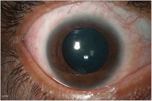 FIGURE 2  Case 2 two months after starting treatment with intravenous daclizumab demonstrates resolution of scleritis.
