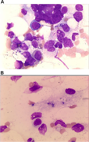 Figure 2 Wright’s staining (1000×), some phagocytes phagocytized suspected Histoplasma capsulatum in the cytoplasm (A). These fungi are surrounded by a transparent halo (B).