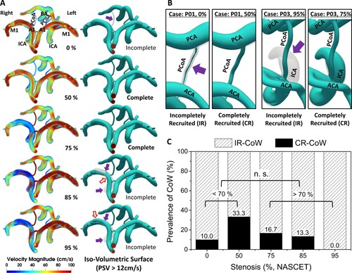 Figure 7. A, 3D velocity contours and the representative iso-volumetric 3D surfaces at the peak systole. The peak systole here represented the maximum velocity magnitude in individual voxels in a cardiac cycle which is a similar representation as MIP in the medical imaging techniques such as transcranial Doppler (TCD) or MRA. The arrows indicated reversed flow from the contralateral side to the iMCA (red; blank), and unrecruited/incompletely recruited arteries (purple; filled); B, the difference between the IR and CR part of the artery segment indicated with and arrow (purple) is shown. The prevalence of CR-CoW during CS progression are presented in C, The prevalence of CR-CoW at each stages of CS. In moderate (<70%) and severe (>70%) groups, there was no difference (n.s.). This implied that IR-CoW can be present depending on the imaging threshold, and CR-CoW be a potential transitional stage between various forms of IR-CoW.