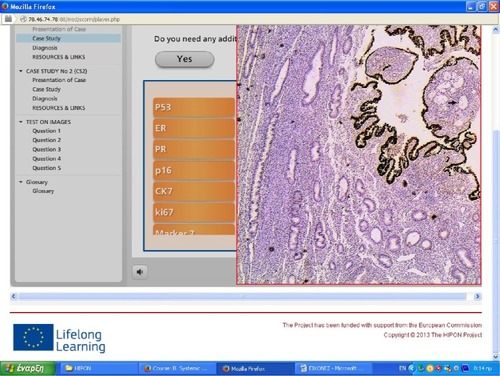 Figure 4 Option of immunohistochemical stain, helpful for defining the correct diagnosis, from a case presentation of an endometrial tumor in HIPON Uterus chapter.