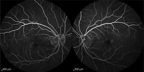 Figure 3 Intravenous fluorescein angiography at month 3.