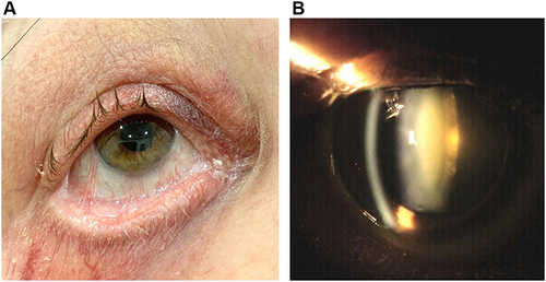 Figure 2 Photographs of the patient’s right eye 8 months after initiation of aggressive immunosuppressive therapy. (A) External photograph of the patient’s right eye shows symblepharon formation and forniceal foreshortening without conjunctival injection. (B) A dense nuclear and posterior subcapsular cataract has formed. The patient’s vision dropped to 20/200 and her intraocular pressure rose to 35 mmHg while on oral and topical steroids.