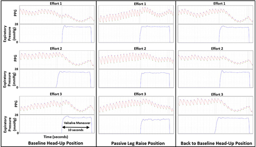 Figure 3 Valsalva Pule Response (VPR) of a Photoplethysmography (PPG) Signal to a Valsalva Maneuver at Head-Up Position, After Passive Leg Raise (PLR), and After Return to Head-Up Position in one typical participant. The signals for each of the 3 Valsalva efforts at each position are shown. Expiratory Pressure = Pressure of an expiratory effort into a mouthpiece leading to closed tube with a pressure transducer, during the 10-second Valsalva maneuver. There are tiny x-marks where the program automatically determines the peaks and valleys.