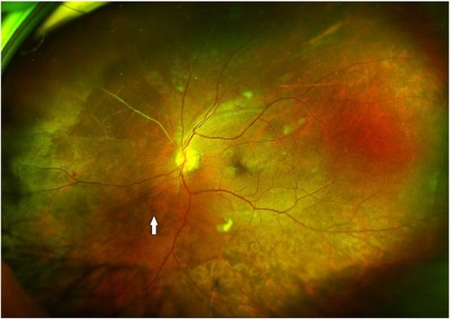 Figure 7 Widefield view of fundus suggestive of PDR. Arrow shows a retinal neovascularization elsewhere, and note the extent of occluded vessels seen in the nasal quadrant.
