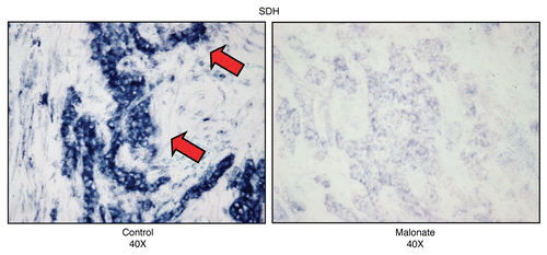 Figure 15 Treatment with malonate (a complex II inhibitor) validates the specificity of SDH activity staining in human epithelial cancer cells. Frozen sections of human breast cancer samples were subjected to SDH activity staining (blue color) in the presence or absence of malonate. However, slides were not counter-stained. Note that sodium malonate (10 mM; a Complex II inhibitor) effectively abolished the SDH activity staining, directly demonstrating high-specificity. Original magnification, 40x.
