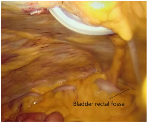 Figure 4. Completing the intra-abdominal catheter fixation (The left side is the head).