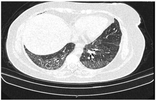 Figure 1. High-resolution chest computerized axial tomography (CAT), showing diffuse bilateral pulmonary fibrosis in P4.