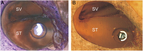 Figure 6. Mid-modiolar sections showing the electrode and sheath within scala tympani (A) cochleostomy insertion, CRC Hear, Melbourne, Australia. (B) round window insertion, Medizinische Hochschule Hannover, Germany. ST, scala tympani; SV, scala vestibuli.