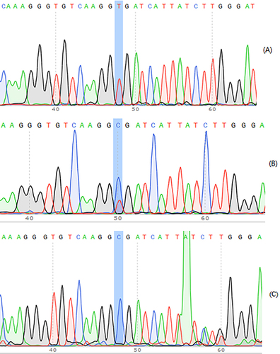 Figure 1 PCR products were sequenced for rs1805017 loci of PLA2G7 gene polymorphism (reverse sequencing). (A) rs1805017-A/A; (B) rs1805017-A/G; (C) rs1805017-G/G.