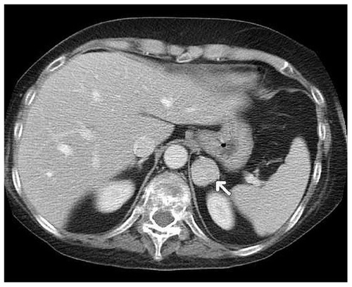 Figure 1 Computed tomographic scan showing a 27 mm lesion in the left adrenal gland.