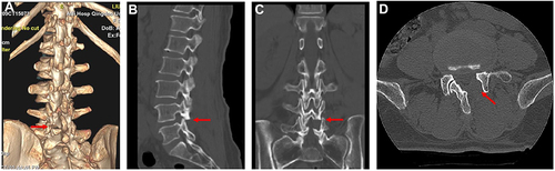 Figure 7 (A–D) Postoperative CT scans images of one patient. The red arrow indicated that the inferior articular process of L4 vertebra was over resected in (A–D). (A) 3 dimensional reconstruction image; (B) sagittal view; (C) coronal view; (D) Axial view.