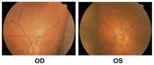 Figure 3 Choroidal detachment observed during fundus examination using indirect Schepens ophthalmoscopy.