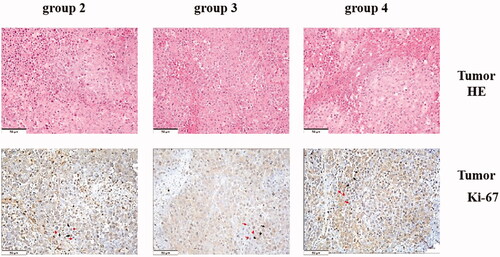 Figure 3. Corosolic acid inhibits tumour growth without compromising associating liver partition and portal vein ligation-induced liver regeneration. (A) The tumour inhibition rate under corosolic acid treatment. (B) The number of Ki-67-positive tumour cells per square millimetre. (C) Immunohistochemical (HIC) staining for tumour cells in the regenerating lobes in each group. (D) Immunohistochemical staining for Ki-67 in tumour tissue in the regenerating lobes in each group. Scale bars, 50 µm. *P < .01 for group 2 compared with group 3; **P < .01 group 3 compared with group 4; ***P < .05 group 2 compared with group 3. The HE staining of cells with violet-blue nuclear deposition pigment was positive; the HE staining of Ki-67 cells with the nuclear deposition of violet pigment was positive (black arrow), and the nuclear deposition of blue pigment was negative (red arrow) (original magnification x200). Values are shown as the means ± the standard deviation. Group 1 is the mock group; group 2 is the implantation without associating liver partition and portal vein ligation (ALPPS) group; group 3 is the implantation/ALPPS group; group 4 is the implantation/ALPPS/CA group.