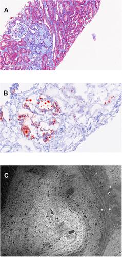 Figure 1 Original biopsy. The length of each bar represents the distance in microns. (A) shows dilated glomerular capillaries filled with mesh-like acellular material (Masson trichrome). (B) shows capillary lumina that are dilated with lipid droplets (Oil-Red-O stain). (C) shows a fingerprint-like structure composed of granules and vacuoles within a capillary lumen. There is expansion (asterisk) of the subendothelial space (electron microscopy, 5000x).