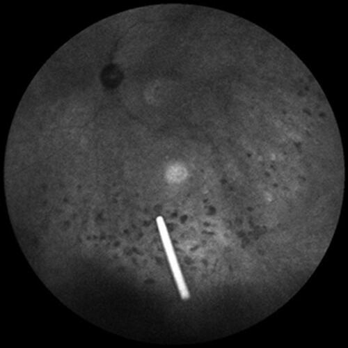Figure 2 Dexamethasone implant floating in the vitreous.