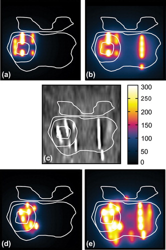 Figure 1. Planned and reconstructed dose distributions (coronal view). The planned focal dose distribution (a), planned total dose distribution (b), CT 4 weeks after implantation (c), reconstructed delivered focal dose (d) and reconstructed total dose (e). Dose color values correspond to the Gray levels given in the color bar. The contours represent the F-GTV, F-PTV, prostate and seminal vesicles.