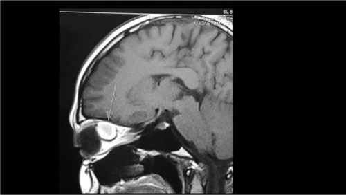 Figure 5 Magnetic resonance imaging showing sagittal section.