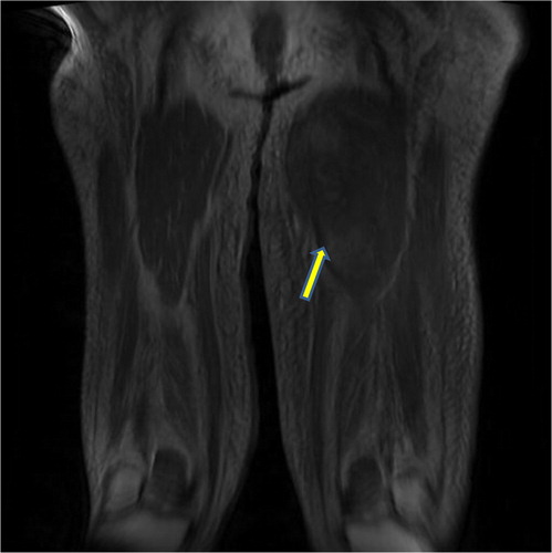 Fig. 2 T2-weighted coronal MRI image of the lower extremities showing edema and breakdown of muscle architecture of the left thigh.