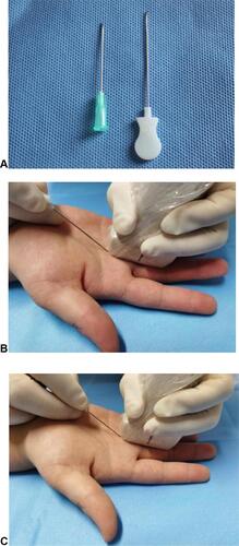 Figure 1 (A) On the left is a 21-Gauge needle (0.8 mm in diameter, 38 mm in length) and on the right is a Hanzhang needle-knife (0.8 mm diameter and 40 mm length); (B) placement of probe and needle-knife under ultrasound-guided percutaneous A1 pulley release by acupotomy; (C) placement of probe and needle under ultrasound-guided percutaneous A1 pulley release by 21-Gauge needle.