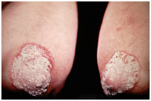 Figure 1 Clinical presentation of plaque-type psoriasis demonstrating well demarcated erythematous plaques with overlying adherent scale.