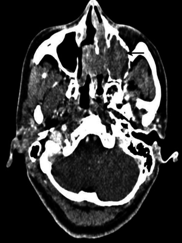 Figure 2 Enhanced CT demonstrated a neoplasm on the left maxillary sinus （black arrow); the size was 4.5 cm*4.0 cm. The nasal septum was obviously compressed, with a right deviation.
