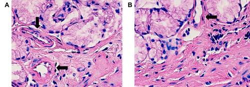 Figure 1 Result of morphological examination of the intestinal wall in patients with cirrhosis of the liver tissue before (A) and after (B) cryoprecipitate introduction. Thickening of walls and increase of diameter of vessels (arrows) in intestinal wall (original magnification x400, coloring with hematoxylin-eosin).