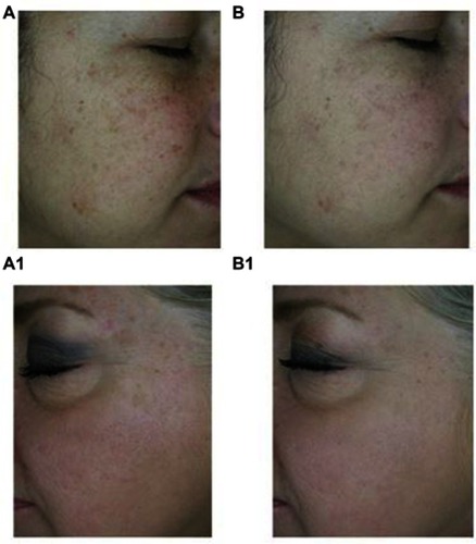 Figure 4 High-resolution pictures of two subjects evaluating dark spots (A and A1: baseline, D0; B and B1: after treatment D28).