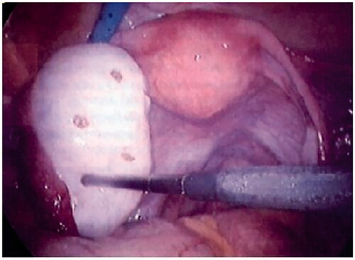 Figure 1. Laparoscopic surgery of ovarian drilling.