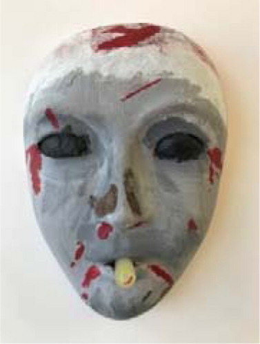 Figure 1. Example patient’s mask from Case Series 1 (Injured/Traumatic Group)