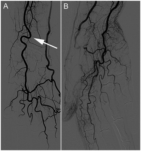 Figure 3. (A) Angiography, showing curved aspect of ulnar artery (white arrow). (B) Decreased flow toward ulnar three digits.