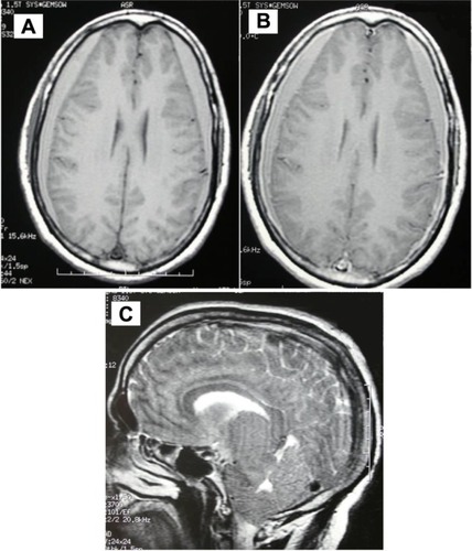 Figure 2 A and B: After lumbar puncture, axial cerebral MRI T1 weighted views, with Gadolinum injection, showing bilateral subdural hematoma. C: Sagittal T2 weighted views, showing tonsilar descent simulating Chiari type I malformation.