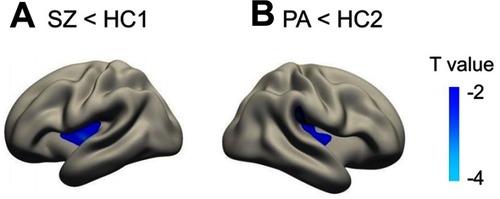 Figure 3 Cortical statistical maps displaying sulcal depth reduction in patients with schizophrenia (SZ) compared with young healthy controls (HC1) (A) and in unaffected biological parents of patients (PA) compared with old healthy controls (HC2) (B). Monte Carlo cluster simulation was used for multiple comparison correction with a threshold of P<0.05. The colour bar indicates T values.