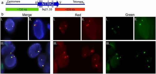 Figure 4. Interphase FISH break apart probe analysis of NTRK2 fusion. (a) Schematic representation of the ZytoLight® SPEC NTRK2 Dual Color Break Apart Probe (not to scale), consisting of a 720 kb 5ʹ green probe (g.86,569,621–87,287,312, ending in intron 4 NM_006180.4, hg19) and a 535 kb 3ʹ red probe (g.87,589,037– 88,124,082, starting in intron 19) in 9q21. (b) One normal fusion-negative cell [I] showing two wild type NTRK2 alleles displayed as two adjacent green (5ʹ)/red (3ʹ) signals (or merged yellow signal). One GKAP1-NTRK2 fusion-positive tumor cell [II] showing the split pattern; one normal NTRK2 allele with green/red (yellow) signal, as well as one 3ʹ NTRK2 split allele with red/green/red signal. Three GKAP1-NTRK2 fusion-positive tumor cells [III] showing the split pattern. All pictures are displayed as three panels; Merged (left), ZyOrange red channel (middle) and ZyGreen green channel (right). Tissue sections were counterstained with DAPI (blue nucleus staining). Original magnification x63