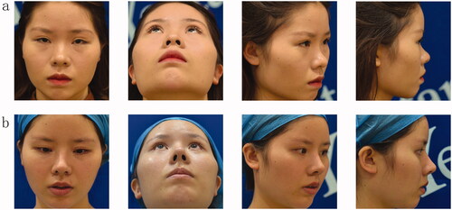 Figure 3. A 24-year-old Asian woman underwent twin tower folding ear cartilage rhinoplasty. Preoperative (a) and postoperative (b) facial profiles are shown.